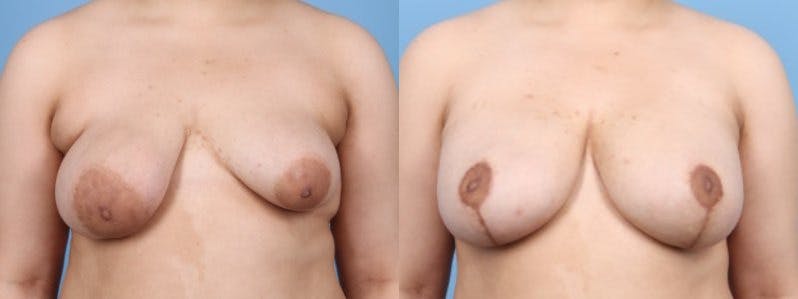 Breast Asymmetry Before & After Gallery - Patient 124069 - Image 1