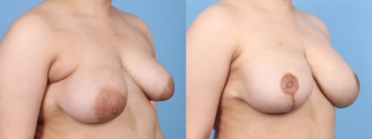 Breast Asymmetry Before & After Gallery - Patient 124069 - Image 2