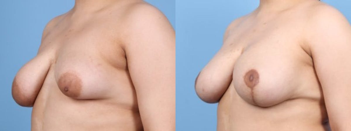 Breast Asymmetry Before & After Gallery - Patient 124069 - Image 3