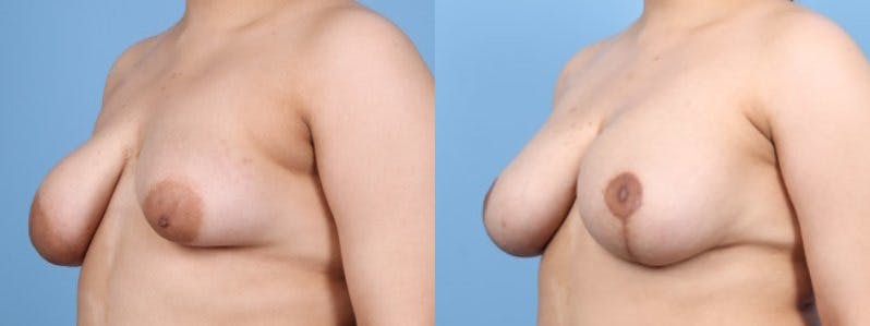 Breast Asymmetry Before & After Gallery - Patient 124069 - Image 3