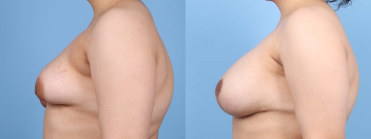 Breast Asymmetry Before & After Gallery - Patient 124069 - Image 4