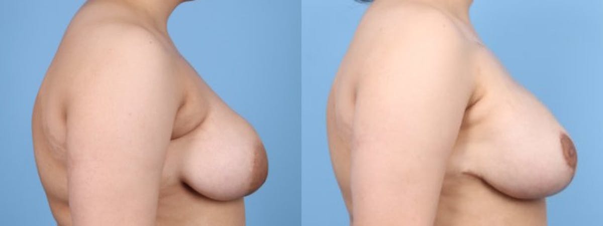 Breast Asymmetry Before & After Gallery - Patient 124069 - Image 5