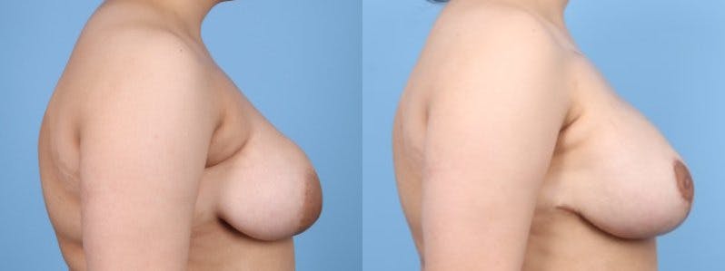 Breast Asymmetry Before & After Gallery - Patient 124069 - Image 5