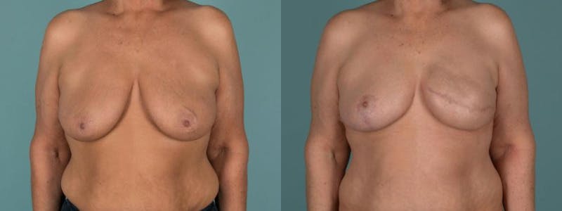 Symmetry Procedures Before & After Gallery - Patient 184433 - Image 1
