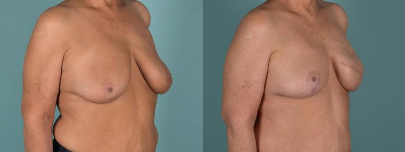 Symmetry Procedures Before & After Gallery - Patient 184433 - Image 2