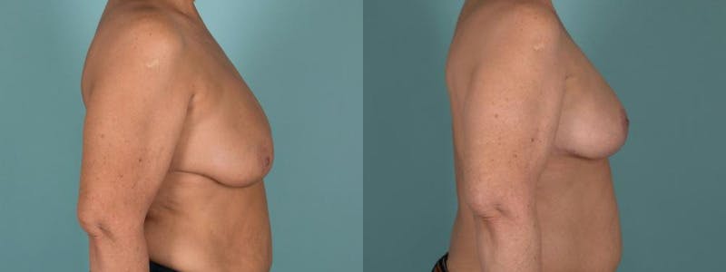 Symmetry Procedures Before & After Gallery - Patient 184433 - Image 3