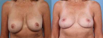Implant Removal Before & After Gallery - Patient 766895 - Image 1