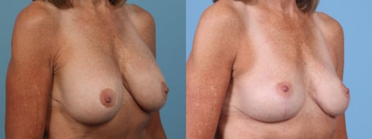 Implant Removal Before & After Gallery - Patient 766895 - Image 2