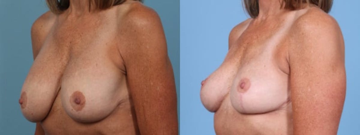Implant Removal Before & After Gallery - Patient 766895 - Image 3