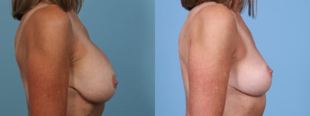 Implant Removal Before & After Gallery - Patient 766895 - Image 5