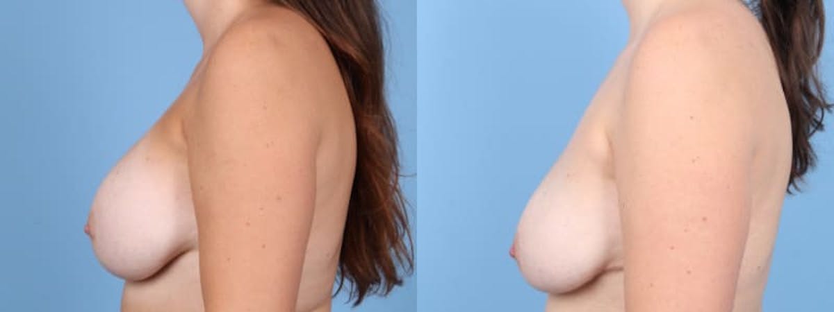Implant Removal Before & After Gallery - Patient 280103 - Image 5