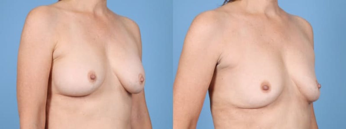 Implant Removal Before & After Gallery - Patient 384483 - Image 2