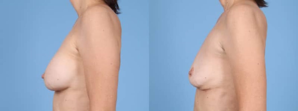 Implant Removal Before & After Gallery - Patient 384483 - Image 5