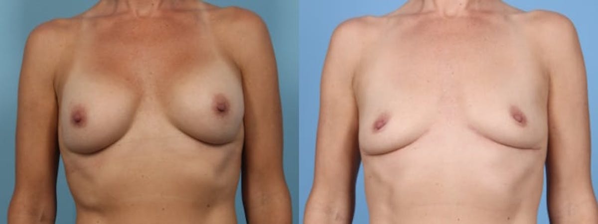 Implant Removal Before & After Gallery - Patient 128885 - Image 1