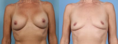 Implant Removal Before & After Gallery - Patient 128885 - Image 1