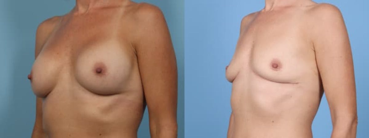 Implant Removal Before & After Gallery - Patient 128885 - Image 2