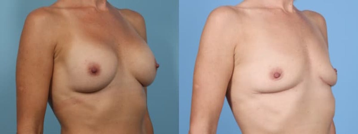 Implant Removal Before & After Gallery - Patient 128885 - Image 3