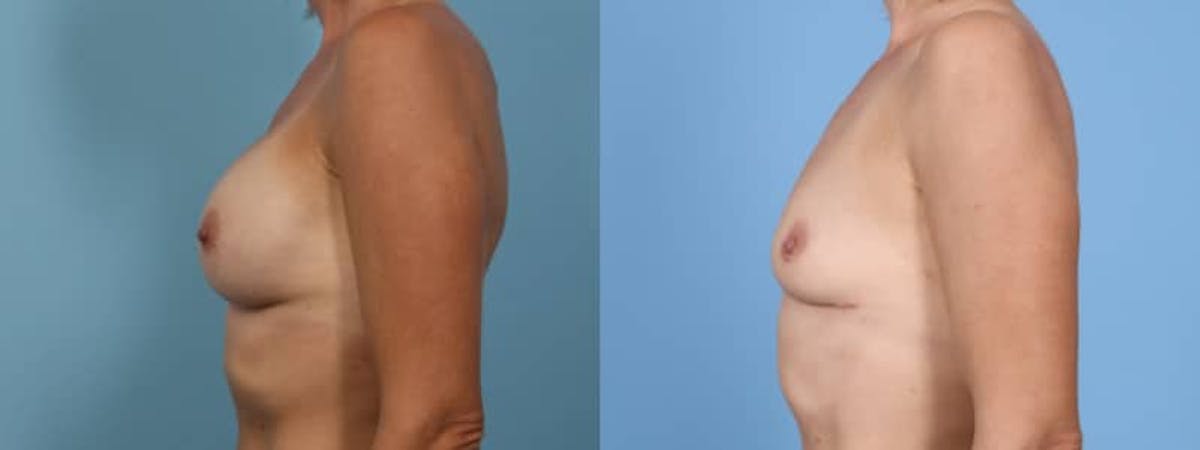 Implant Removal Before & After Gallery - Patient 128885 - Image 4