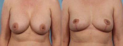 Implant Removal w/ Fat Grafting Before & After Gallery - Patient 202906 - Image 1