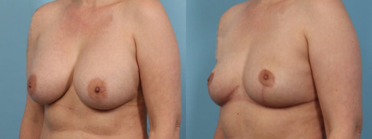 Implant Removal Before & After Gallery - Patient 327557 - Image 2