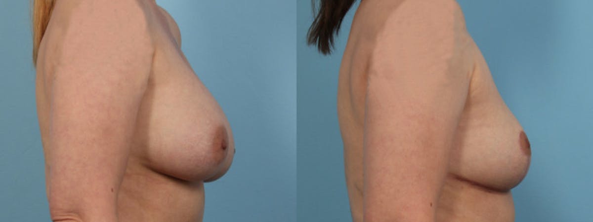 Implant Removal Before & After Gallery - Patient 327557 - Image 4