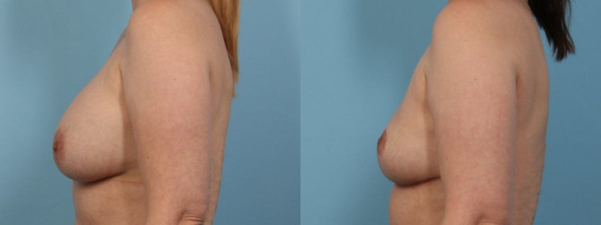 Implant Removal Before & After Gallery - Patient 327557 - Image 5