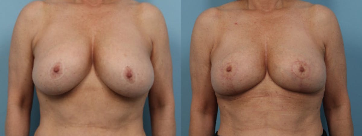Implant Removal w/ Fat Grafting Before & After Gallery - Patient 181326 - Image 1