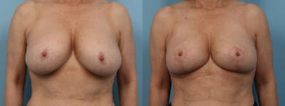 Implant Removal w/ Fat Grafting Before & After Gallery - Patient 181326 - Image 1