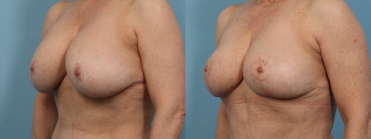 Implant Removal w/ Fat Grafting Before & After Gallery - Patient 181326 - Image 2