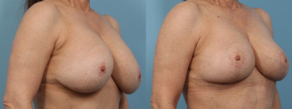 Implant Removal w/ Fat Grafting Before & After Gallery - Patient 181326 - Image 3