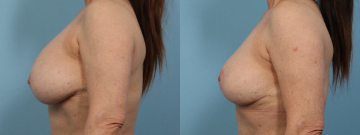 Implant Removal w/ Fat Grafting Before & After Gallery - Patient 181326 - Image 4