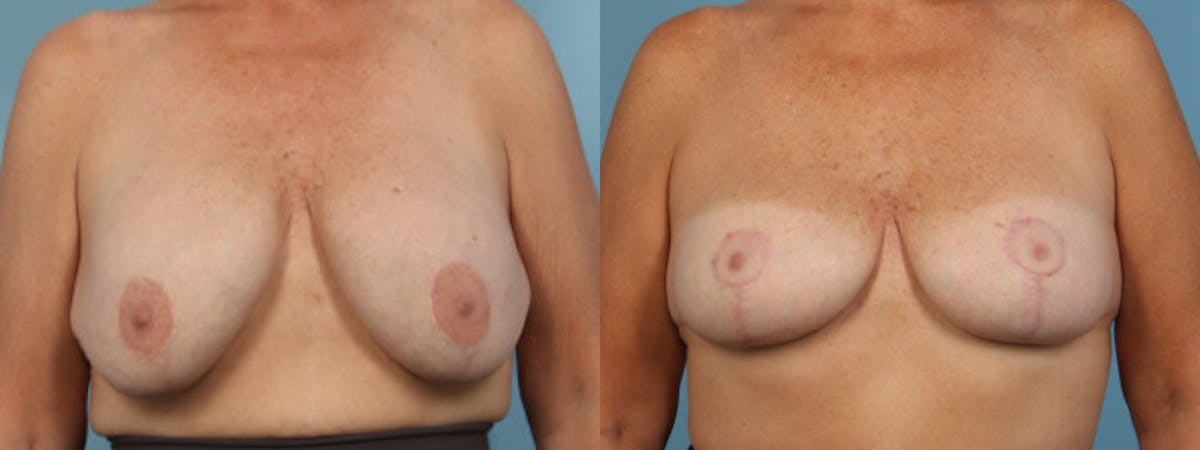 Implant Removal Before & After Gallery - Patient 137720 - Image 1