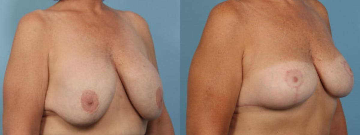 Implant Removal Before & After Gallery - Patient 137720 - Image 2
