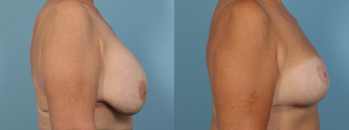 Implant Removal Before & After Gallery - Patient 137720 - Image 3