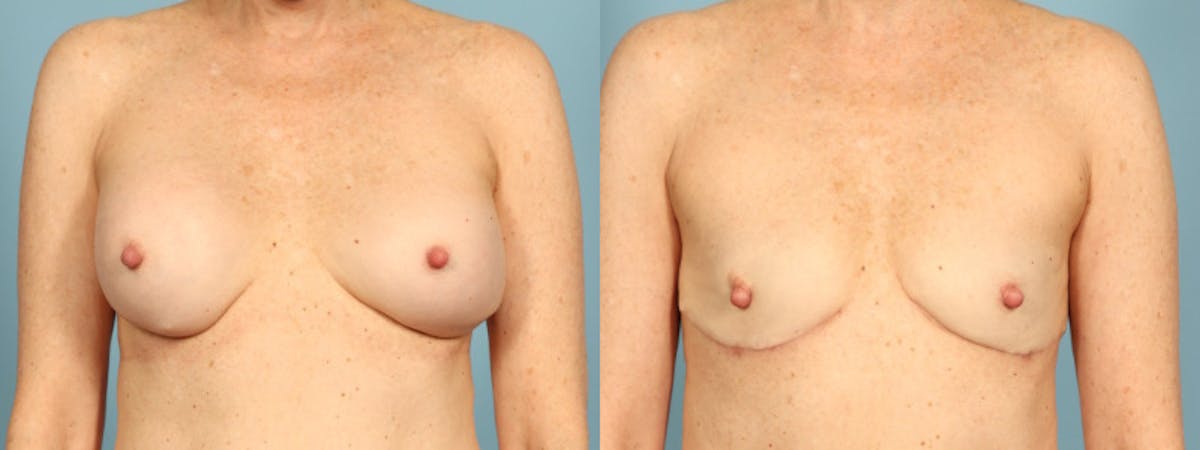Implant Removal Before & After Gallery - Patient 255612 - Image 1