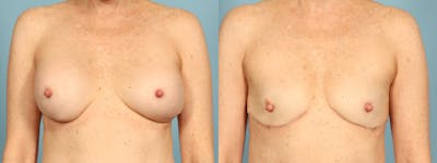 Implant Removal Before & After Gallery - Patient 255612 - Image 1