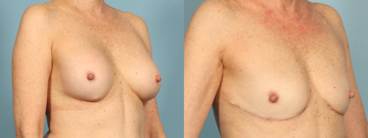 Implant Removal Before & After Gallery - Patient 255612 - Image 2