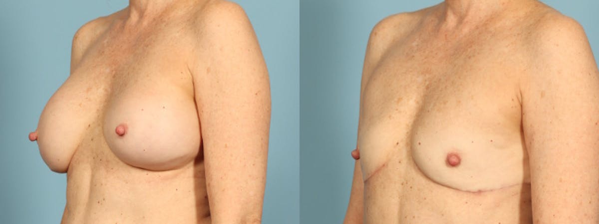Implant Removal Before & After Gallery - Patient 255612 - Image 3