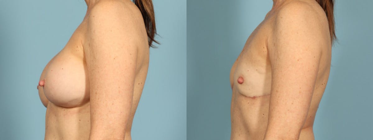 Implant Removal Before & After Gallery - Patient 255612 - Image 4