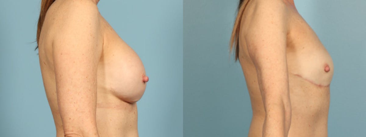 Implant Removal Before & After Gallery - Patient 255612 - Image 5