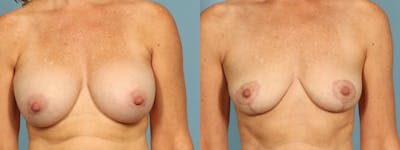 Implant Removal Before & After Gallery - Patient 178507 - Image 1