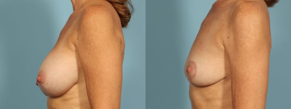 Implant Removal Before & After Gallery - Patient 178507 - Image 2