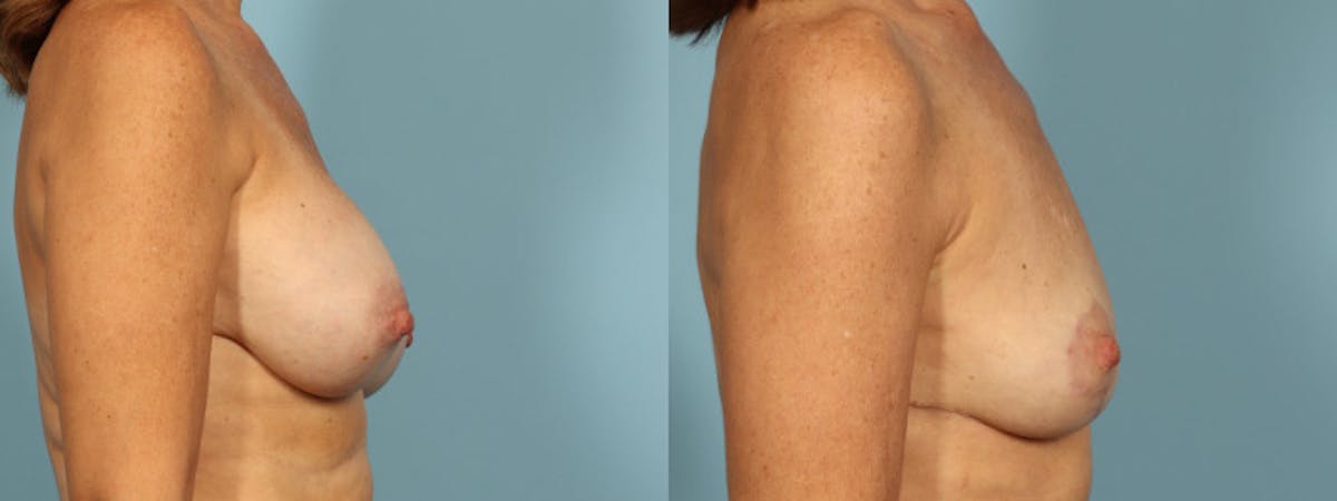 Implant Removal Before & After Gallery - Patient 178507 - Image 3