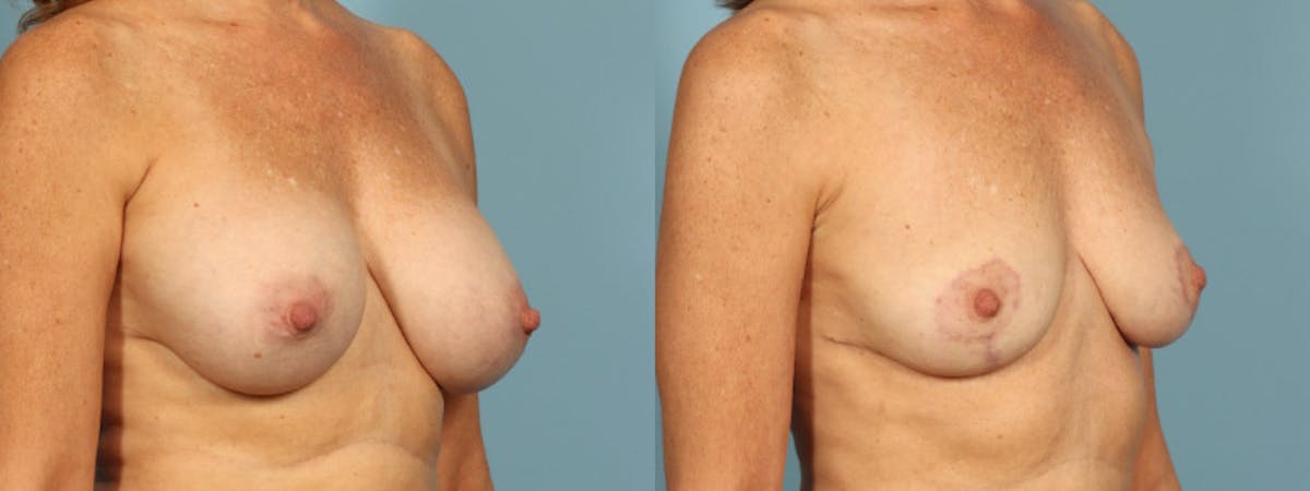 Implant Removal Before & After Gallery - Patient 178507 - Image 4