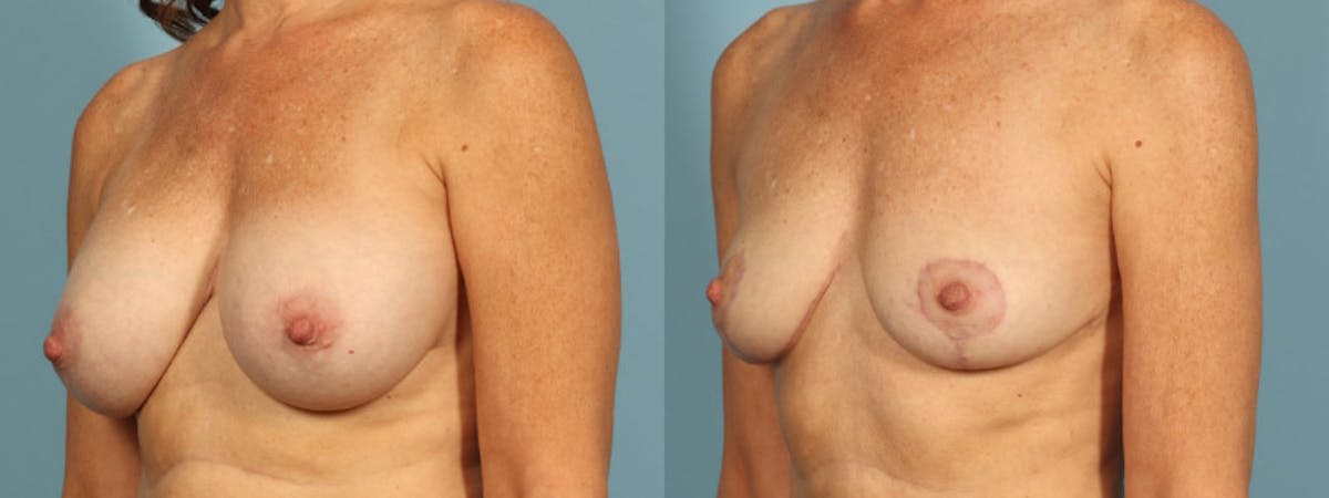 Implant Removal Before & After Gallery - Patient 178507 - Image 5