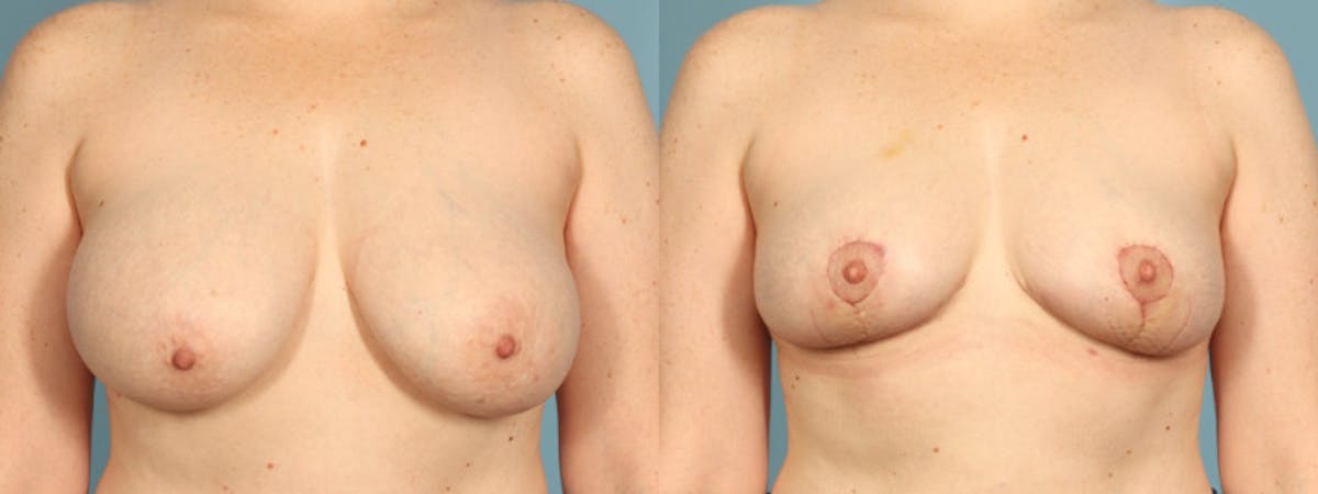 Implant Removal Before & After Gallery - Patient 165827 - Image 1