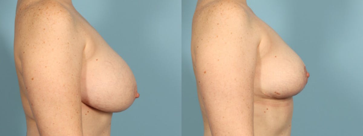 Implant Removal Before & After Gallery - Patient 165827 - Image 2