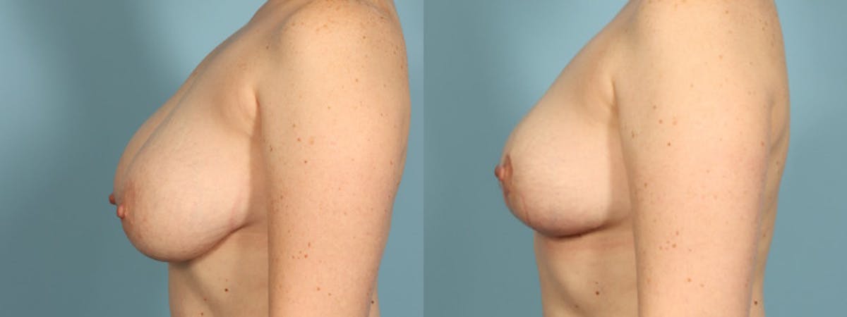 Implant Removal Before & After Gallery - Patient 165827 - Image 3