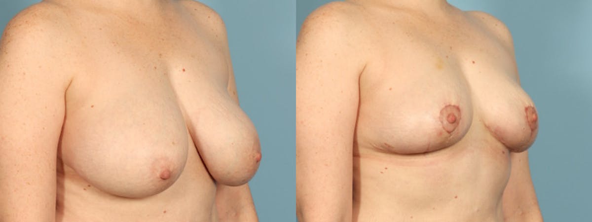 Implant Removal Before & After Gallery - Patient 165827 - Image 4
