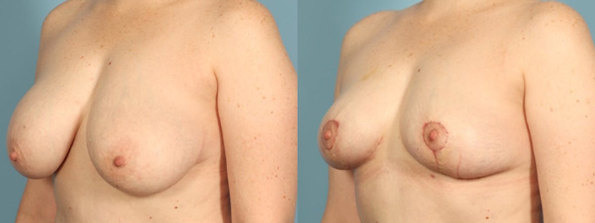 Implant Removal Before & After Gallery - Patient 165827 - Image 5